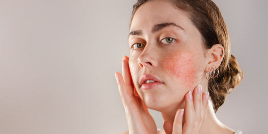 HELP! Ik heb rosacea...