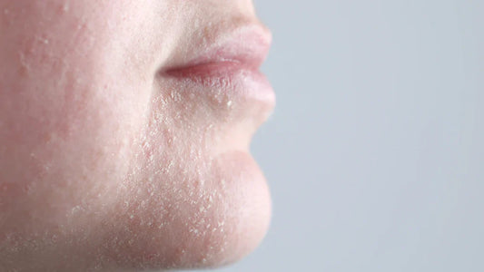 Droge, schilferige huid: Oorzaken, behandeling en productadvies